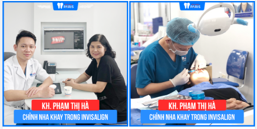 Case Niềng Răng Số 418 - Không Bao Giờ Là Quá Muộn Để Chỉnh Nha