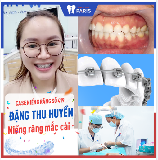 Case Niềng Răng Số 419 - Điều Chỉnh Khớp Cắn Đối Đầu