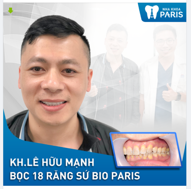 Case Răng Sứ Số 355 - Hô Biến Hàm Răng Ố Xỉn Nhiễm Tetracylin