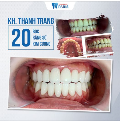 Case Răng Sứ Số 360 - Lột Xác Nụ Cười Với Răng Sứ Kim Cương