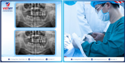 Case trồng răng Implant cho cô Nhung đến từ Long Biên- Hà Nội