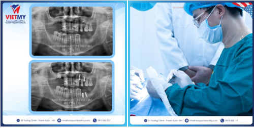 Case trồng răng Implant cho cô Nhung đến từ Long Biên- Hà Nội