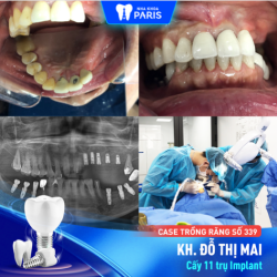 Case Trồng Răng Số 339 - Giải Pháp Nào Khi Bị Mất Nhiều Răng