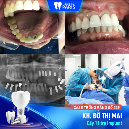 Case Trồng Răng Số 339 - Giải Pháp Nào Khi Bị Mất Nhiều Răng