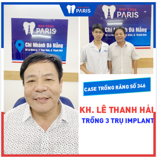 Case Trồng Răng Số 346 - Bền Chắc Trọn Đời Với Trụ Implant