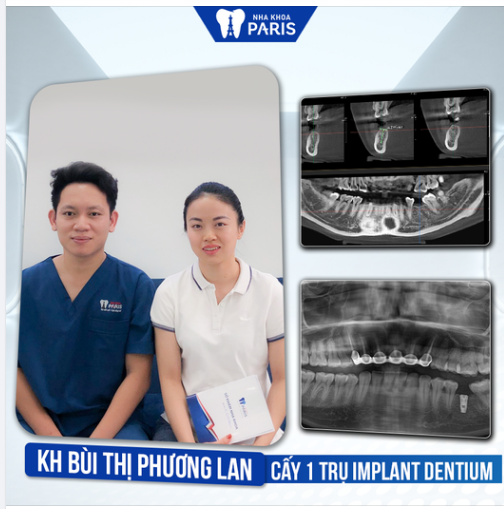 Case Trồng Răng Số 350 - Phục Hình Răng Mất Với Trụ Dentium Hàn Quốc