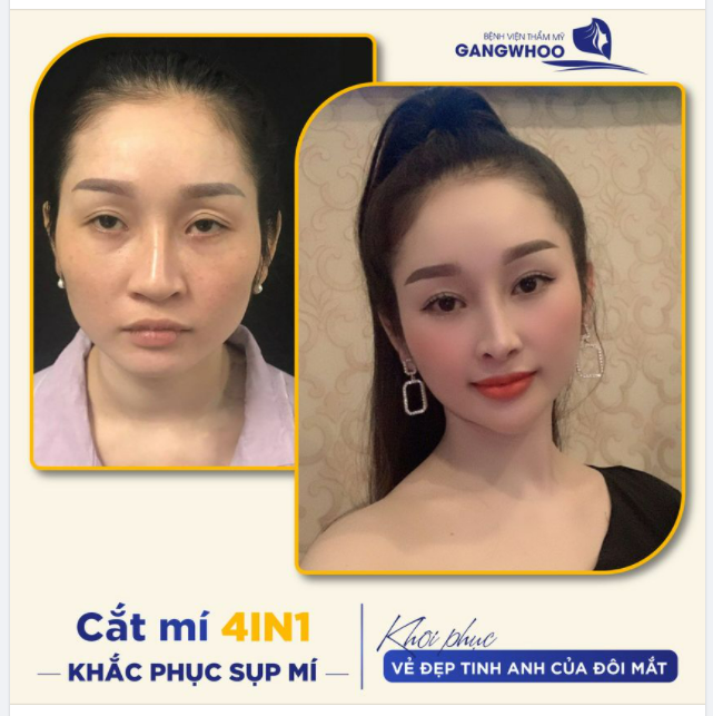 CẮT MÍ 4IN1 - KHẮC PHỤC SỤP MÍ, KHÔI PHỤC VẺ TINH ANH CHO ĐÔI MẮT