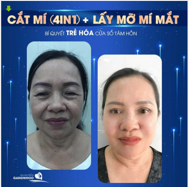 CẮT MÍ (4IN1) + LẤY MỠ BỌNG MẮT - BÍ QUYẾT TRẺ HÓA CỬA SỔ TÂM HỒN