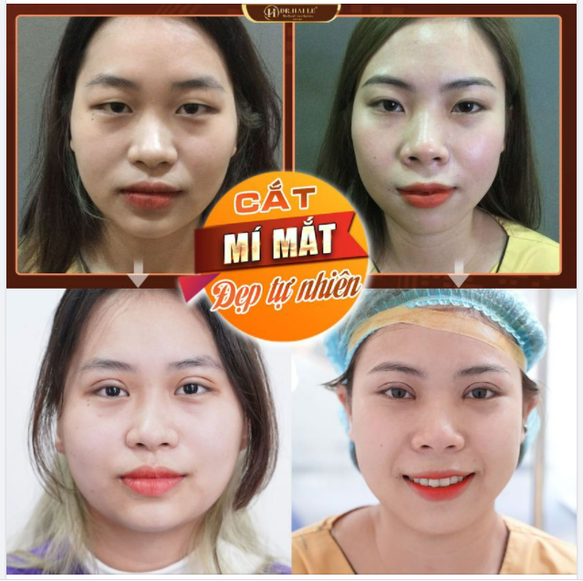 Cắt mí cực xinh "RINH" ưu đãi HOT nhất tháng 6