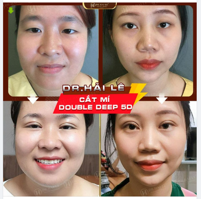 CẮT MÍ DOUBLE DEEP 5D - KỸ THUẬT CẮT MÍ ĐỘC QUYỀN TẠI DR.HẢI LÊ.!