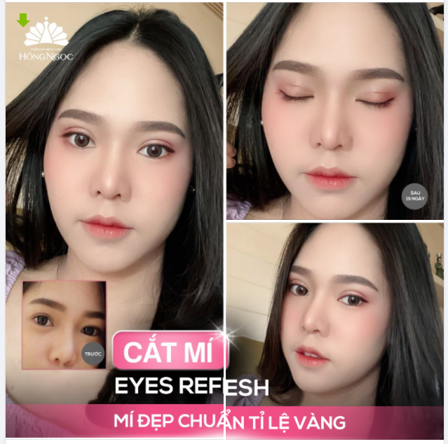 Cắt mí Eyes Refesh - Hết ""Phèn"" ngay sau 45P