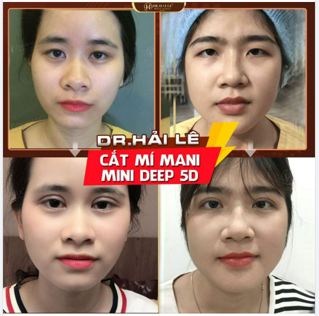 CẮT MÍ Mani Mini Deep 5D.!!