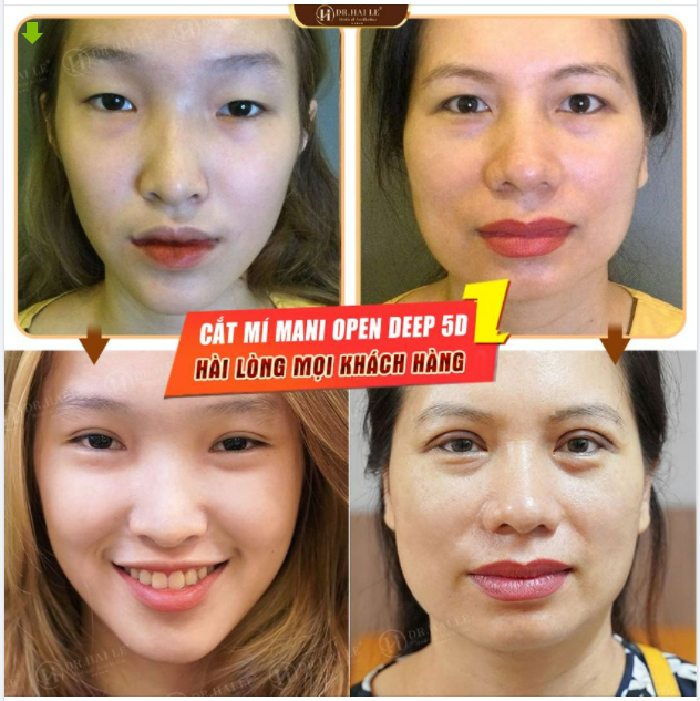 CẮT MÍ MANI OPEN DEEP 5D - BAO LÂU THÌ LÀNH VÀ ĐẸP TỰ NHIÊN?