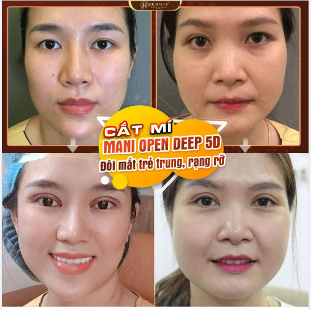 CẮT MÍ MANI OPEN DEEP 5D TẠI DR.HẢI LÊ.!!