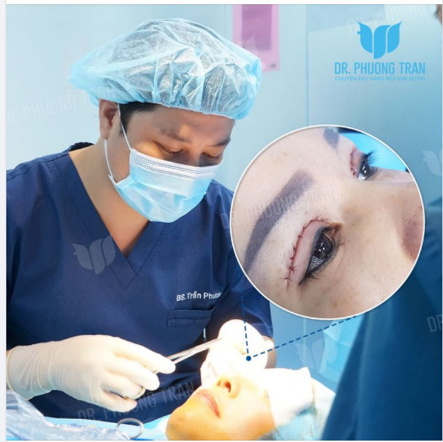 CẮT MÍ MẮT - DỄ MÀ KHÓ