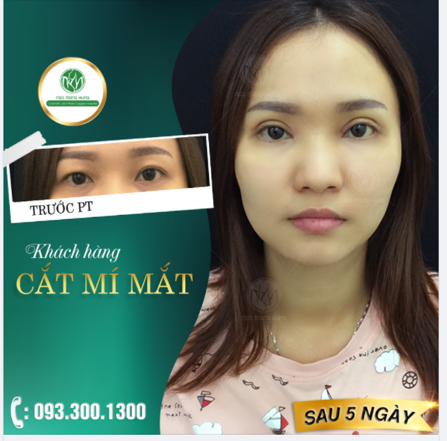 CẮT MÍ MẮT - PHƯƠNG PHÁP SỞ HỮU ĐÔI MẮT 2 MÍ ĐẸP HOÀN HẢO