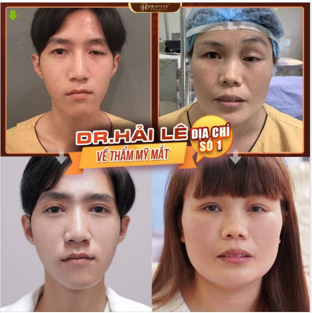 Cắt mí MK (mí khó) tại Dr.Hải Lê