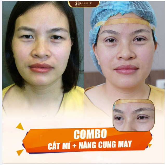 Cắt mí Nâng cung mày - Giải pháp thẩm mỹ hoàn hảo cho đôi mắt trẻ trung, rạng rỡ.!!