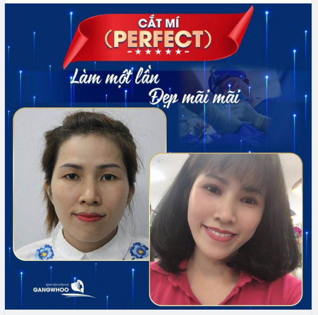 CẮT MÍ (PERFECT) - LÀM MỘT LẦN, ĐẸP MÃI MÃI