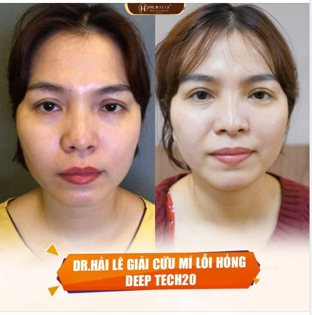 Cắt mí quá to, nếp mí 2 bên không đều nhau - PHẢI LÀM SAO