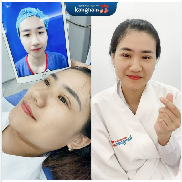Cắt mí xong - Hối hận quá