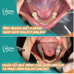 CẤY GHÉP IMPLANT - GIẢI PHÁP TRỌN ĐỜI CHO RĂNG MẤT