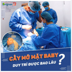 CẤY MỠ MẶT DUY TRÌ ĐƯỢC BAO LÂU?
