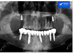 Cấy thêm 2 Implant hàm trên, R16, R26, phục hình sau 2 tháng.