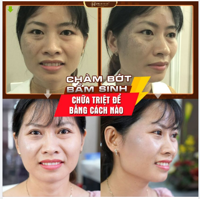 Chàm bớt bẩm sinh có chữa dứt điểm được không? Điều trị bằng phương pháp nào hiệu quả hiện nay