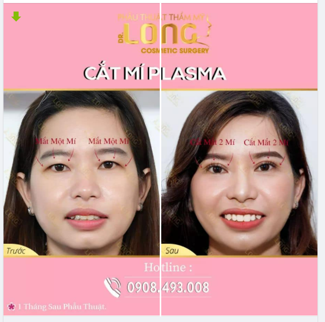 CHĂM SÓC MẮT SAU CẮT MÍ ĐÚNG CÁCH