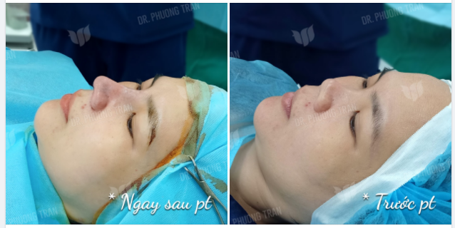 "CHỊ CHỈ MONG CÓ ĐƯỢC CHIẾC MŨI CAO TỰ NHIÊN, HÀI HÒA VỚI GƯƠNG MẶT"