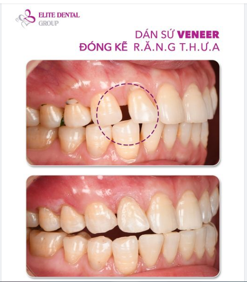 “Chị chưa bao giờ chụp hình góc mặt bên này chỉ vì những chiếc răng t.h.ư.a”