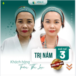 Chị không muốn nhiều nám Nhưng nám nhiều quá nên chị phải đi chữa...