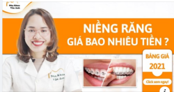 CHI PHÍ NIỀNG RĂNG MỚI NHẤT 2021 - LOẠI NÀO RẺ NHẤT