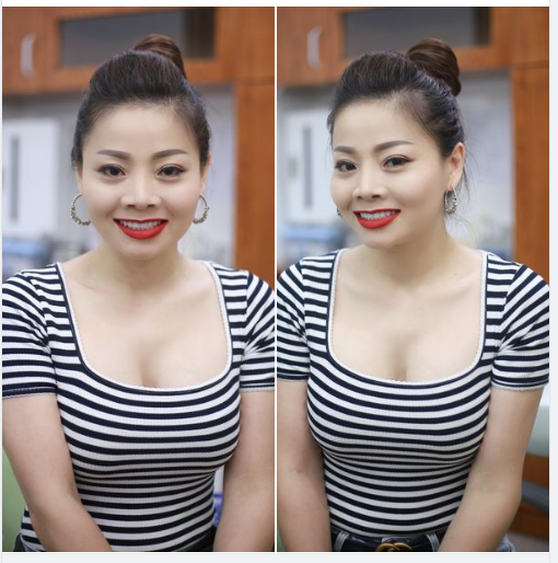 Chỉ sau 2 lần hẹn cùng chuyên gia của Nha khoa Gia Đình, chị khách đã thay đổi hoàn toàn diện mạo nụ cười của mình trở nên rạng ngời, tươi tắn