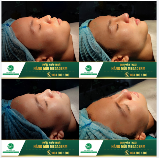 CHỈ SAU 30 PHÚT CÓ NGAY DÁNG MŨI ĐẸP
