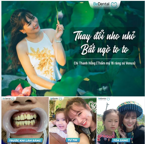 Chị Thanh Hồng quyết định vươt hơn 120km từ Thái Bình lên Hà Nội để thay đổi nụ cười, chỉnh sửa khuyết điểm
