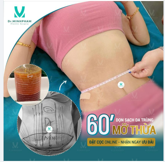 CHIA TAY BỤNG MỠ - ĐẸP HẾT CỠ  HÚT MỠ BỤNG BIO NANO ƯU ĐÃI SỐC CHỈ 8TR/VÙNG