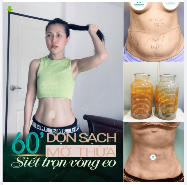 CHIA TAY BỤNG MỠ - ĐẸP HẾT CỠ HÚT MỠ BỤNG BIO NANO ƯU ĐÃI SỐC CHỈ 8TR/VÙNG