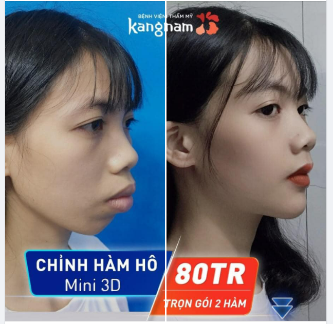 Chỉnh hàm hô TRỌN GÓI chỉ 80TR