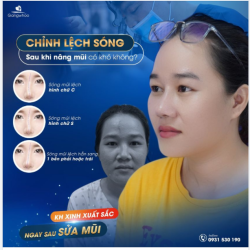 CHỈNH LỆCH SÓNG SAU KHI NÂNG MŨI CÓ KHÓ KHÔNG