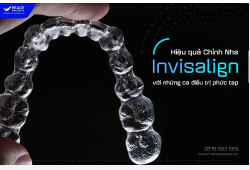 CHỈNH NHA INVISALIGN CÓ HIỆU QUẢ CAO VỚI NHỮNG CA PHỨC TẠP, KHÓ 