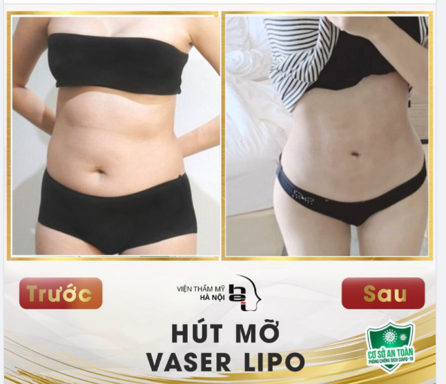 Chinh phục eo thon cùng Vaser Lipo chỉ trong 45 phút!