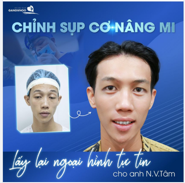 CHỈNH SỤP CƠ NÂNG MI - LẤY LẠI NGOẠI HÌNH TỰ TIN CHO KHÁCH HÀNG