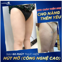 CHO CHÂN THÊM NHẸ - CHO NÀNG THÊM YÊU CÙNG HÚT MỠ CÔNG NGHỆ CAO LIPO ULTRASOUND