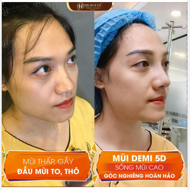 Chọn Dr.Hải Lê để "Trao mặt gửi vàng" và kết quả hoàn hảo với nâng mũi Demi 5D