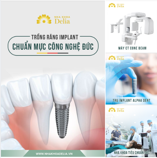 CHỌN TRỒNG RĂNG IMPLANT - CHỌN CÔNG NGHỆ CHUẨN ĐỨC