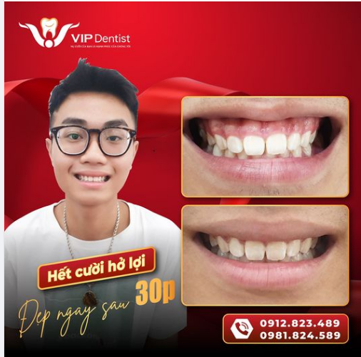 CHỮA CƯỜI HỞ LỢI - ĐÁNH THỨC NỤ CƯỜI TỰ TIN TRONG BẠN