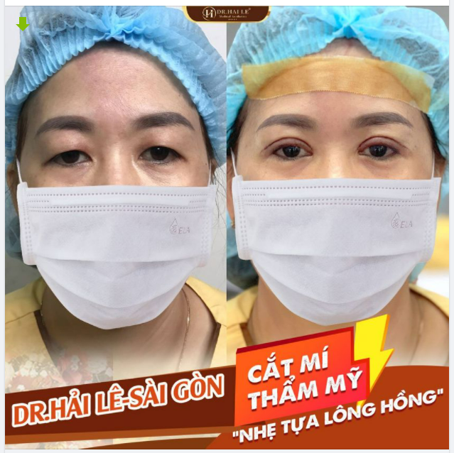 Chưa từng 1 lần thẩm mỹ trước đó.. Thế rồi Cắt mí xong lại muốn làm nhiều dịch vụ hơn nữa vì cắt mí không hề đau, vô cùng nhẹ nhàng.