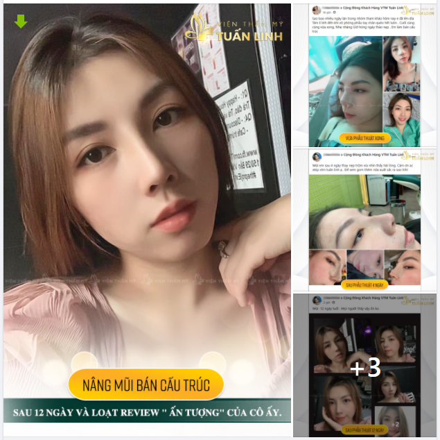 CHÙM ẢNH: REVIEW NÂNG MŨI BÁN CẤU TRÚC SAU 12 NGÀY TẠI TUẤN LINH - ĐỌC XONG CHỈ MUỐN NÂNG LUÔN